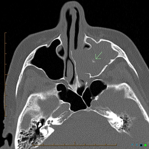 File:Chronic invasive fungal sinusitis with mycetoma (Radiopaedia 27430-27626 Axial bone window 1).jpg