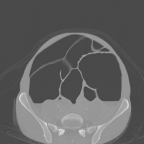 Chronic large bowel pseudo-obstruction (Radiopaedia 43181-46492 Axial bone window 126).jpg