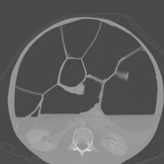Chronic large bowel pseudo-obstruction (Radiopaedia 43181-46492 Axial bone window 89).jpg