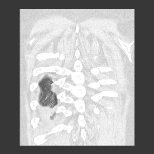 File:Chronic lung allograft dysfunction - restrictive form (Radiopaedia 60595-68316 Coronal lung window 85).jpg