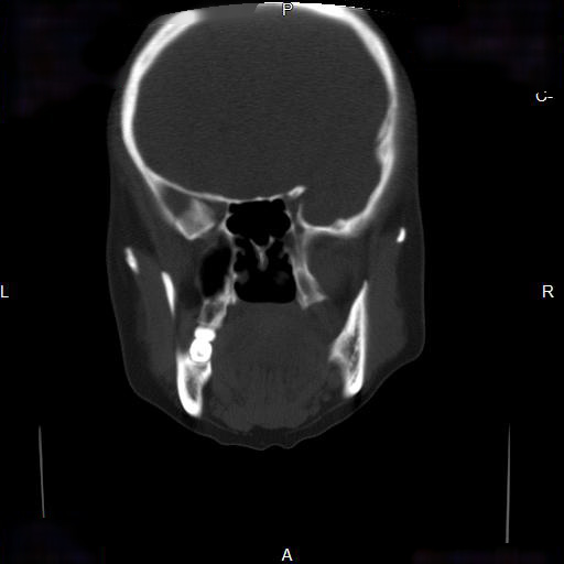 File:Chronic maxillary sinusitis with a foreign body (dental filling material) (Radiopaedia 7811-8639 Coronal bone window 10).jpg