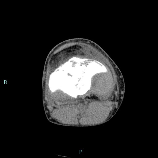 Chronic osteomyelitis (with Brodie abscess) (Radiopaedia 76405-88111 A 108).jpg