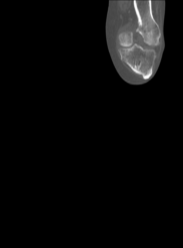 Chronic osteomyelitis - tibia (with sequestrum) (Radiopaedia 73273-84090 Coronal non-contrast 5).jpg