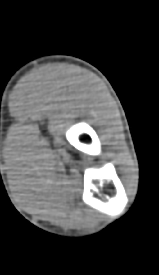 Chronic osteomyelitis of the distal humerus (Radiopaedia 78351-90971 Axial non-contrast 108).jpg