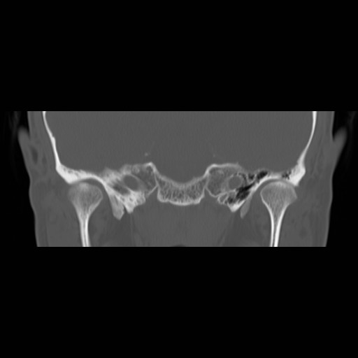 File:Chronic otomastoiditis (Radiopaedia 27138-27309 Coronal bone window 4).jpg