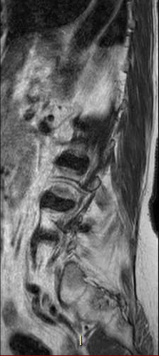 File:Chronic spinal hematoma with cauda equina syndrome (Radiopaedia 75745-87090 Sagittal T2 1).png