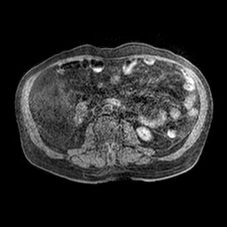 Cirrhosis and hepatocellular carcinoma in the setting of hemochromatosis (Radiopaedia 75394-86594 Axial T1 C+ fat sat 3).jpg