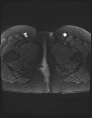 Class II Mullerian duct anomaly- unicornuate uterus with rudimentary horn and non-communicating cavity (Radiopaedia 39441-41755 Axial DWI 31).jpg