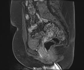 File:Class II Mullerian duct anomaly- unicornuate uterus with rudimentary horn and non-communicating cavity (Radiopaedia 39441-41755 G 59).jpg
