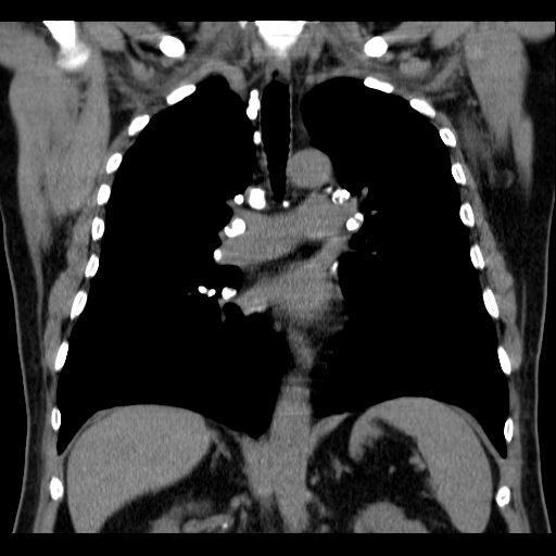 File:Classic complicated silicosis (Radiopaedia 49720-54961 Coronal liver window 33).jpg