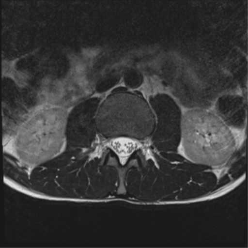File:Clear cell meningoma - lumbar spine (Radiopaedia 60116-67690 Axial T2 32).png
