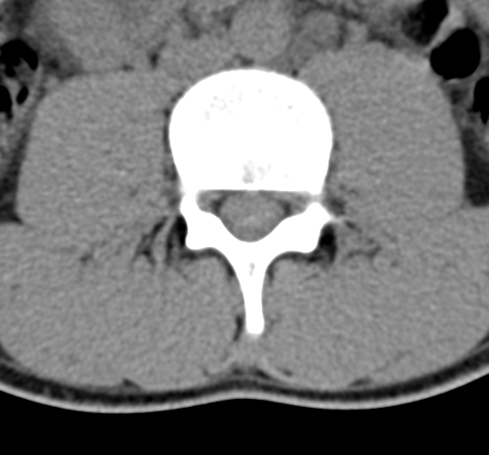 Clear cell meningoma - lumbar spine (Radiopaedia 60116-67691 Axial non-contrast 40).png