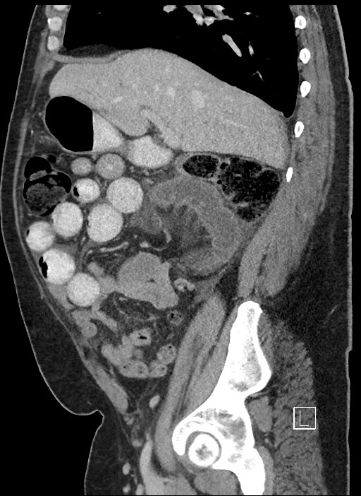 Closed loop obstruction - internal hernia into nephrectomy bed (Radiopaedia 59867-67320 C 67).jpg