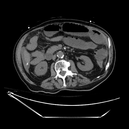 Closed loop obstruction due to adhesive band, resulting in small bowel ischemia and resection (Radiopaedia 83835-99023 Axial non-contrast 66).jpg