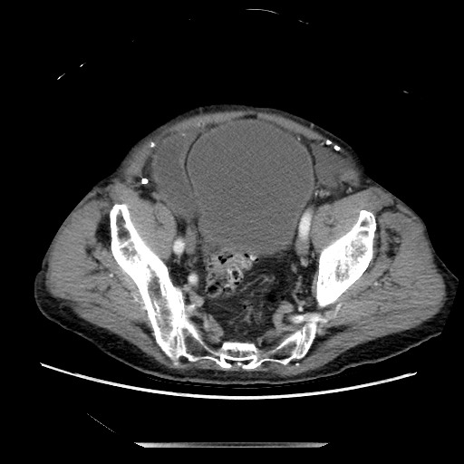 Closed loop small bowel obstruction - adhesive disease and hemorrhagic ischemia (Radiopaedia 86831-102990 A 148).jpg