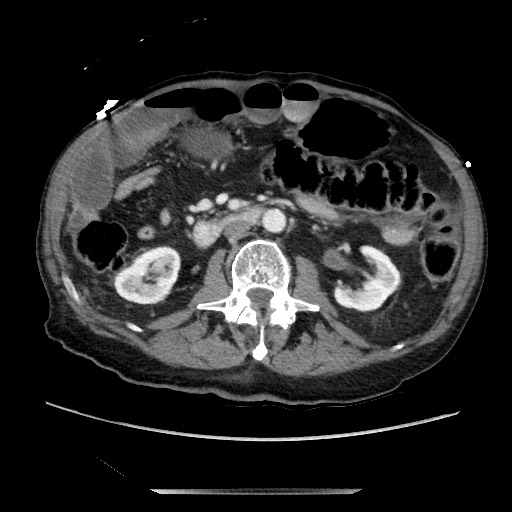 Closed loop small bowel obstruction - adhesive disease and hemorrhagic ischemia (Radiopaedia 86831-102990 A 91).jpg