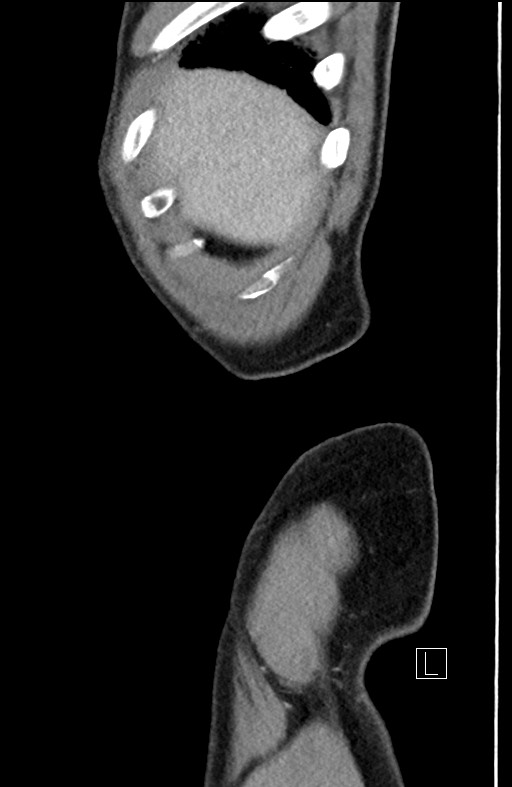 Closed loop small bowel obstruction - internal hernia (Radiopaedia 57806-64778 C 107).jpg