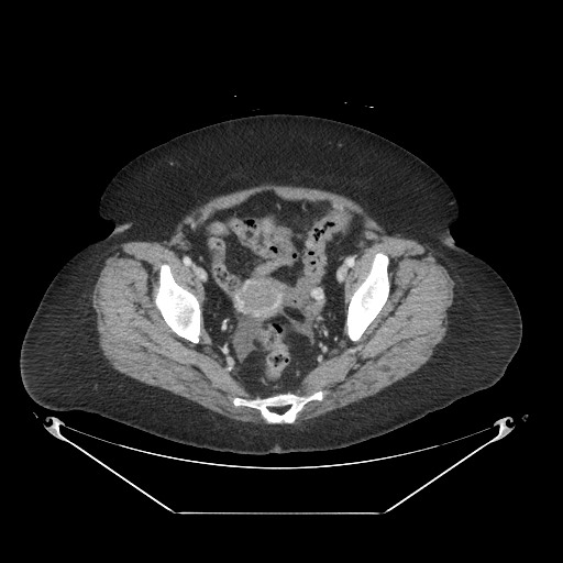 Closed loop small bowel obstruction - internal hernia (Radiopaedia 65402-74450 A 114).jpg