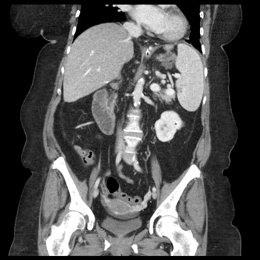 Closed loop small bowel obstruction - internal hernia (Radiopaedia 65402-74450 B 60).jpg