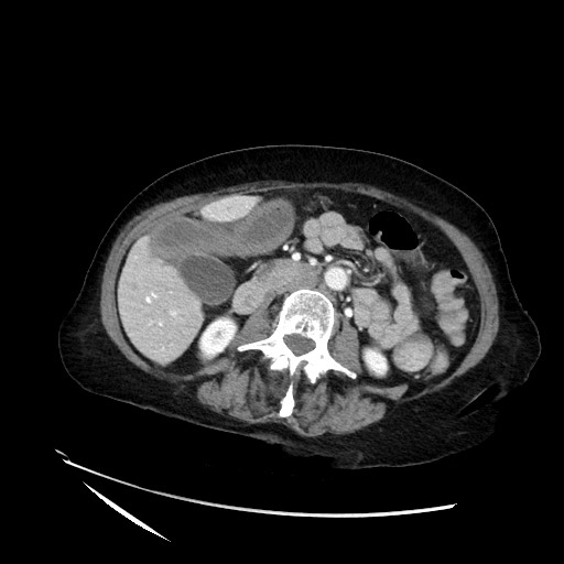 File:Closed loop small bowel obstruction due to adhesive band, with intramural hemorrhage and ischemia (Radiopaedia 83831-99017 Axial 25).jpg