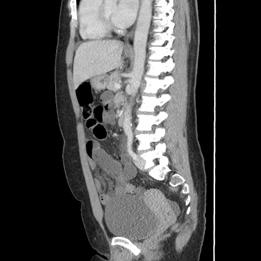 Closed loop small bowel obstruction due to trans-omental herniation (Radiopaedia 35593-37109 C 37).jpg
