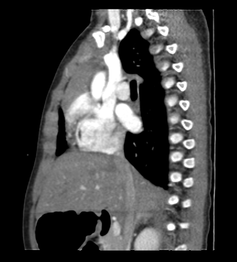 Coarctation of aorta (Radiopaedia 27427-27622 Sagittal C+ CTPA 48).png