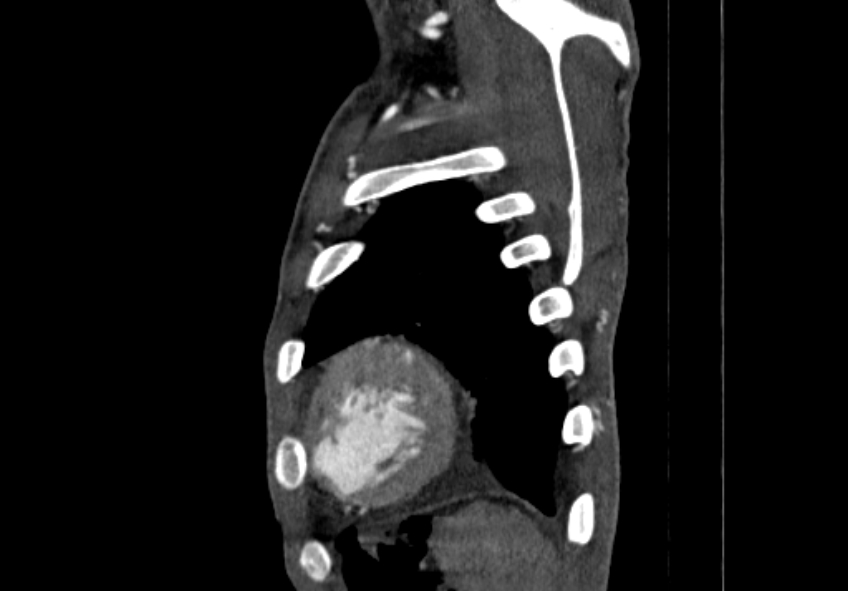 Coarctation of aorta with aortic valve stenosis (Radiopaedia 70463-80574 B 220).jpg