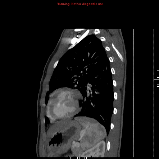 File:Coarctation of the aorta (Radiopaedia 9434-10118 B 48).jpg