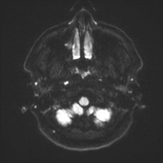 Cochlear incomplete partition type III associated with hypothalamic hamartoma (Radiopaedia 88756-105498 Axial DWI 43).jpg