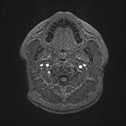 File:Cochlear incomplete partition type III associated with hypothalamic hamartoma (Radiopaedia 88756-105498 Axial T1 8).jpg