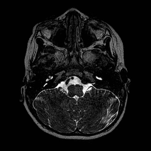 File:Cochlear nerve aplasia - unilateral (Radiopaedia 87910-104413 Axial T2 11).jpg