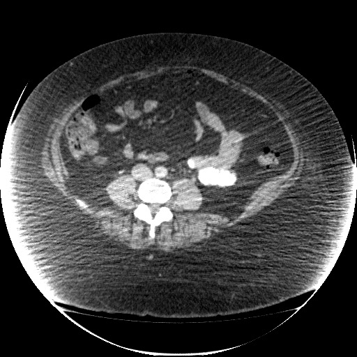 File:Collection due to leak after sleeve gastrectomy (Radiopaedia 55504-61972 A 51).jpg