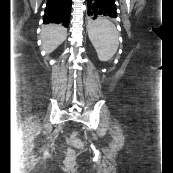 File:Collection due to leak after sleeve gastrectomy (Radiopaedia 55504-61972 B 36).jpg