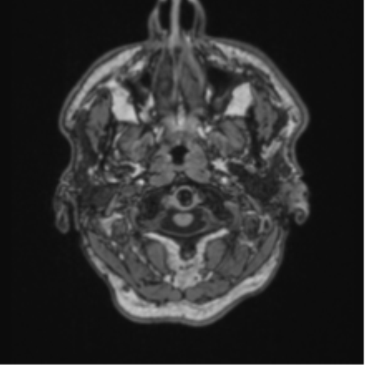 File:Colloid cyst of the third ventricle (Radiopaedia 86571-102662 Axial T1 5).png
