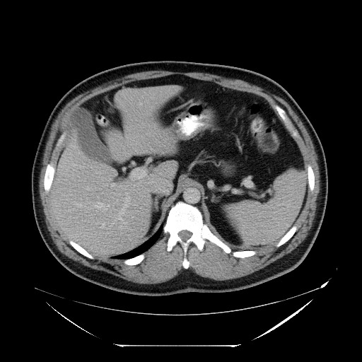 Colocolic intussusception due to lipoma (Radiopaedia 73712-84508 A 30).jpg