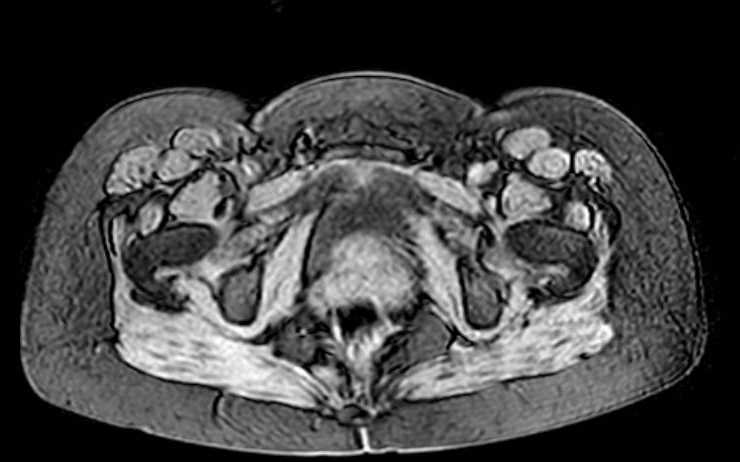 Colon adenocarcinoma with Krukenberg tumors, advanced pregnancy (Radiopaedia 67279-76645 A 8).jpg
