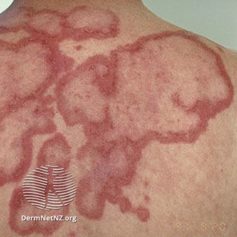 Cutaneous lupus erythematosus (DermNet NZ immune-lupus-erythematosus-2525).jpg