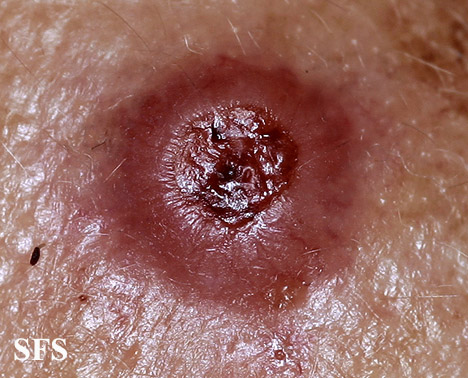 File:Melanoma (Dermatology Atlas 21).jpg