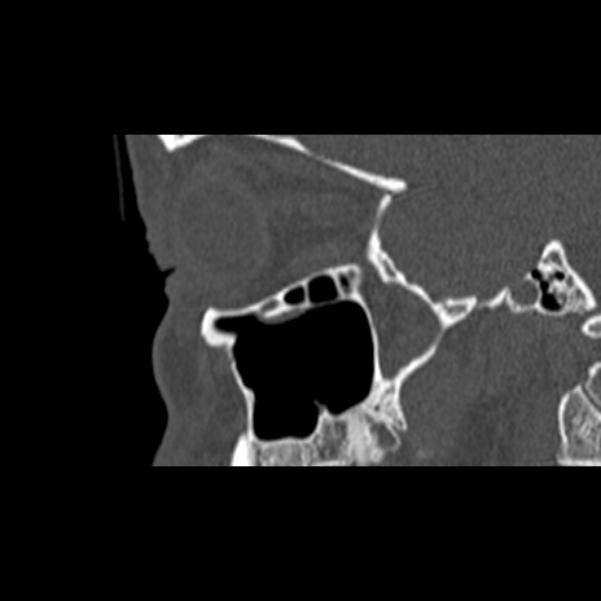 Nasal septal perforation (Radiopaedia 25030-25289 Sagittal bone window 58).jpg