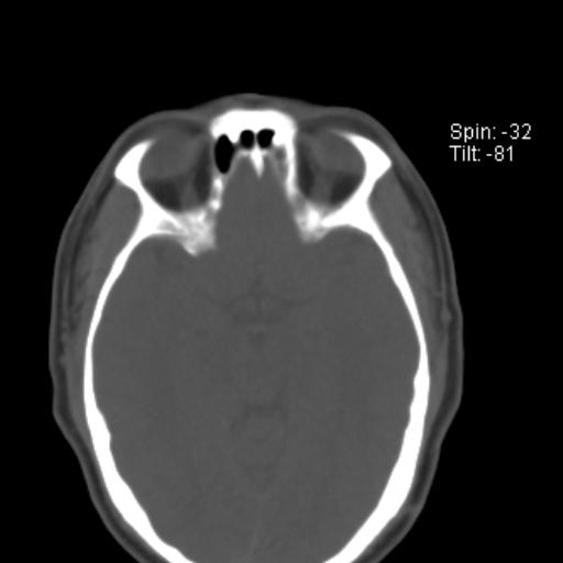 File:Nasolabial cyst (Radiopaedia 28401-28650 Axial bone window 8).jpg