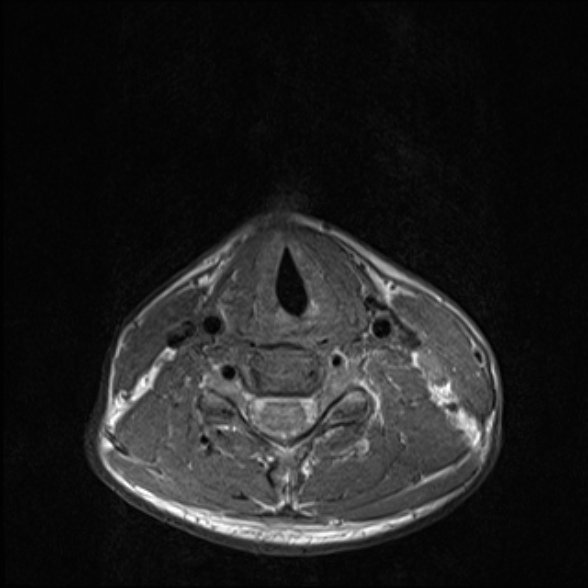 File:Nasopharyngeal carcinoma with skull base invasion (Radiopaedia 53415-59485 Axial T1 58).jpg