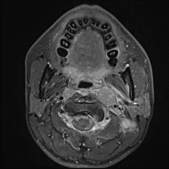 File:Nasopharyngeal carcinoma with skull base invasion (Radiopaedia 53415-59485 Axial T1 C+ fat sat 36).jpg