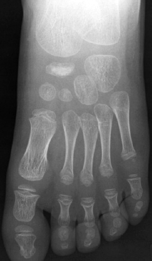 File:Navicular avascular necrosis (Köhler disease) (Radiopaedia 51545-57324 Frontal 1).jpg
