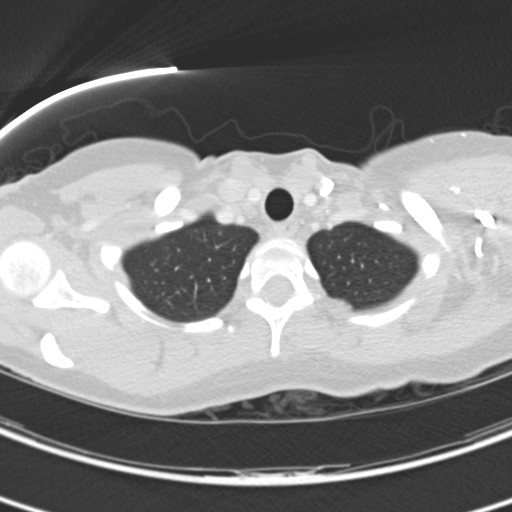 Necrobiotic pulmonary nodules - Crohn disease (Radiopaedia 20723-20631 Axial lung window 16).jpg