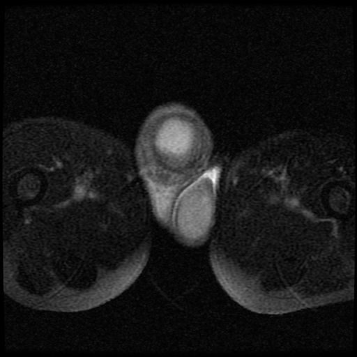 File:Necrotizing epididymo-orchitis with intra-testicular abscess (Radiopaedia 29397-29860 Axial T2 fat sat 15).jpg