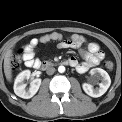 File:Necrotizing pancreatitis with acute necrotic collection (Radiopaedia 14470-14417 B 21).jpg