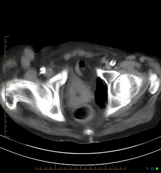 Necrotzing fasciitis due to a perforated adenocarcinoma of the splenic flexure (Radiopaedia 46930-51455 A 61).jpg