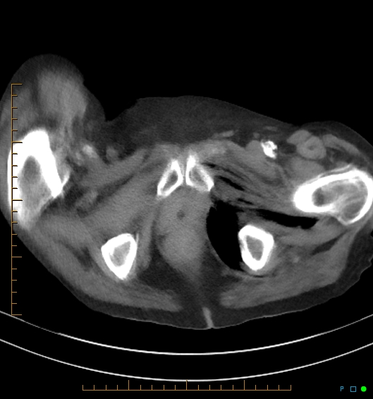 Necrotzing fasciitis due to a perforated adenocarcinoma of the splenic flexure (Radiopaedia 46930-51455 A 65).jpg
