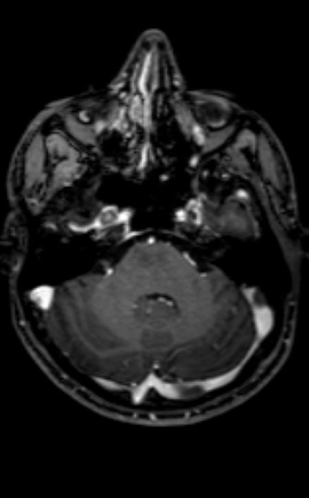 Neuro-Behçet disease (Radiopaedia 90112-107294 Axial T1 C+ 169).jpg