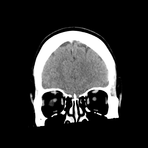 Neurocysticercosis - granular nodular (Radiopaedia 42786-45957 Coronal C+ 14).png